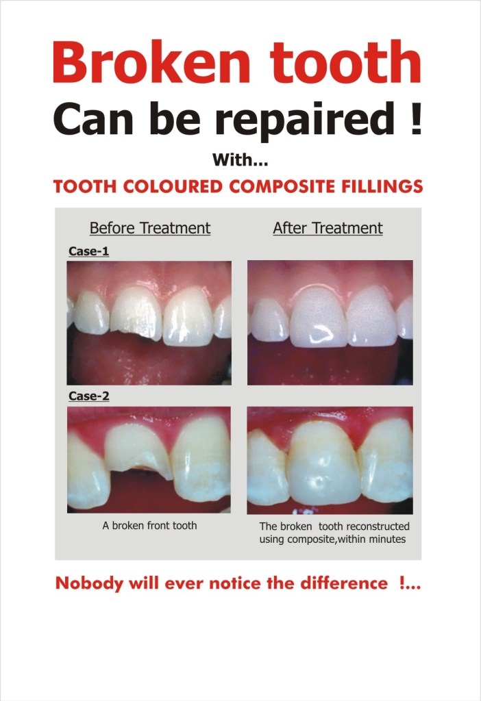 composite-filling