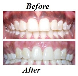 laser-gum-care