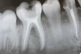 Root Filling Xray